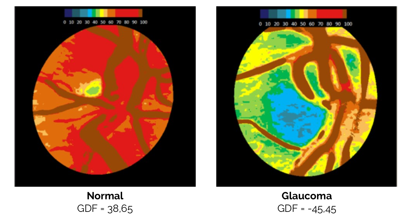RetinaLyze A revolution in screening